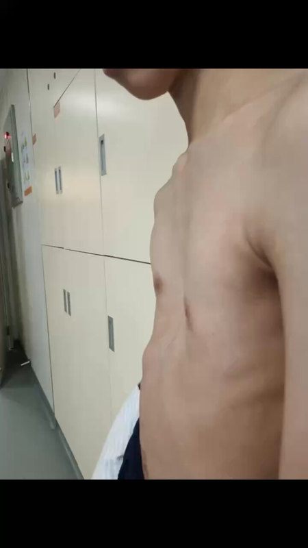 湖南省儿童医院漏斗胸微创治疗