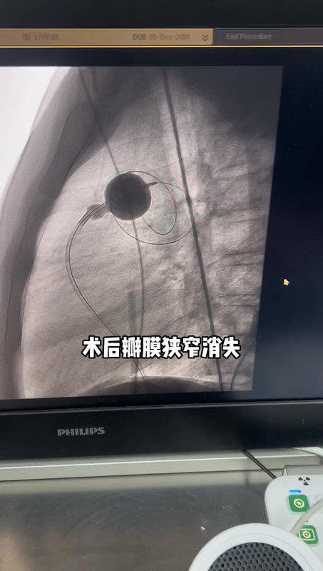 肺动脉瓣狭窄球囊扩张术