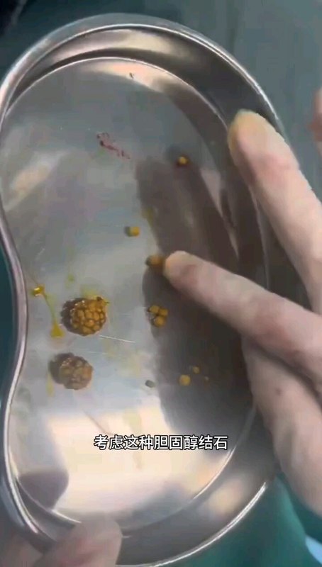 保胆取石经验分享