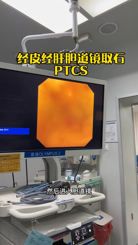 经皮经肝胆道镜取石（PTCS），适合多次胆道术后，以一根引流管的切口，解决肝内胆管结石