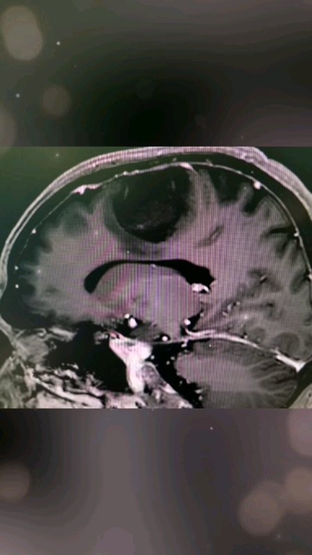 胶质瘤（左额叶），全切肿瘤，术后肢体活动良好…