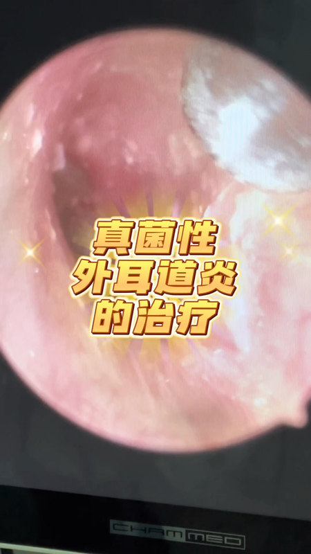 真菌性外耳道炎需要坚持治疗