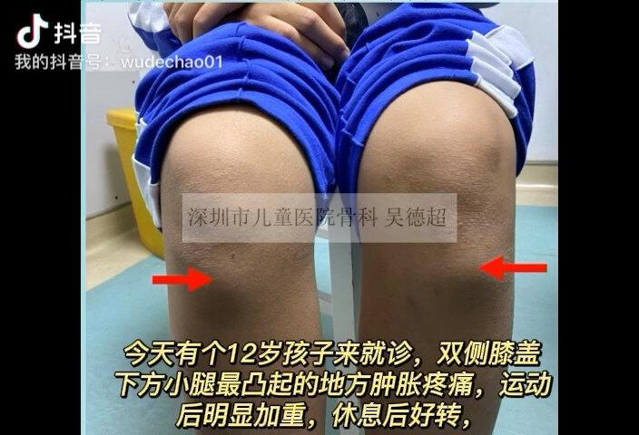 小腿的膝盖下方凸起的部位反复肿痛为哪般？--胫骨结节骨软骨炎