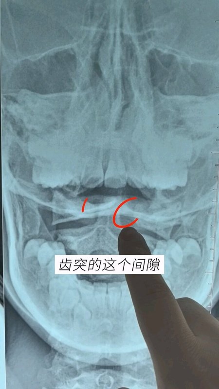 青少年头痛常见原因之一寰枢椎关节损伤