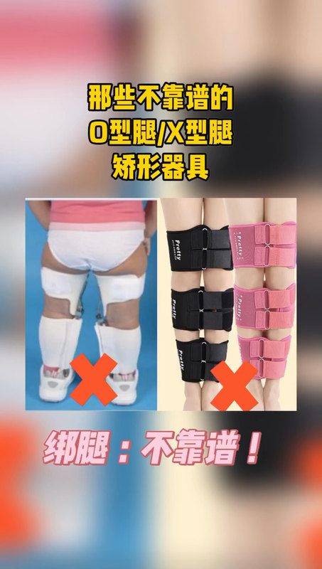 那些不靠谱的O型腿/X型腿矫形器具