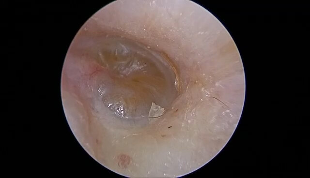 分泌性中耳炎长期治疗无效
                    耳内镜下鼓膜置管术解决问题