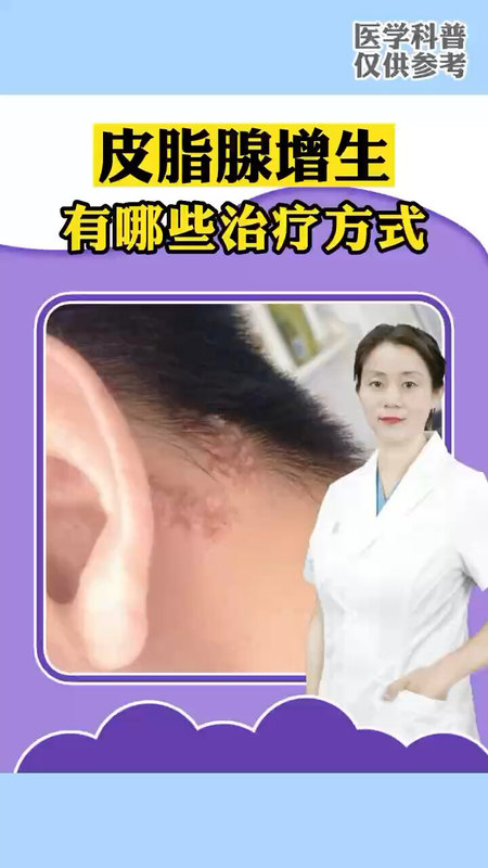 皮脂腺增生有哪些治疗方式