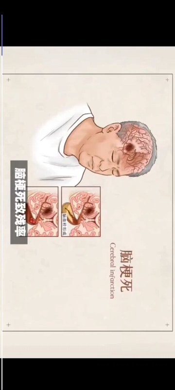 如何尽早预防脑梗死的发生？