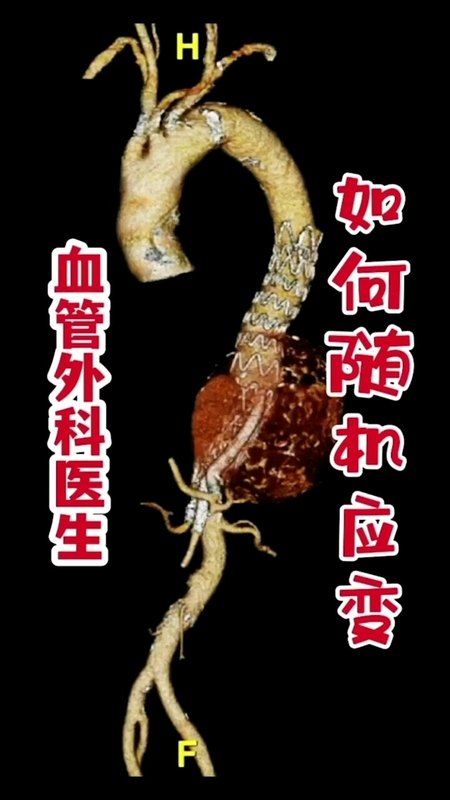胸腹主动脉瘤术后内漏。手术越复杂，困难准备越要充分。