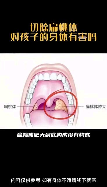 扁桃体切了有害吗？