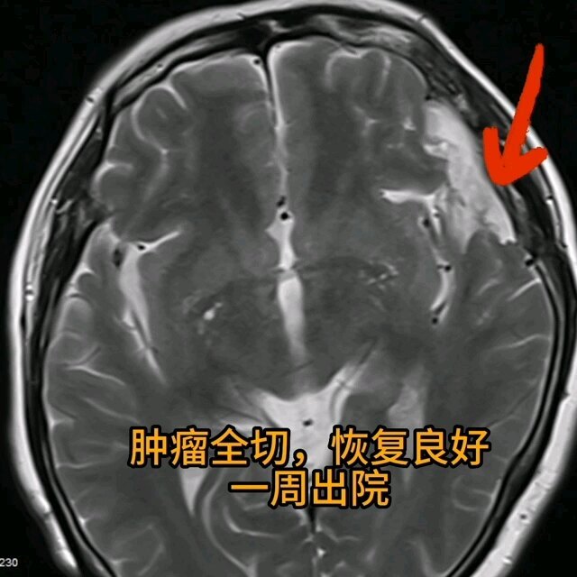 脑膜瘤，手术