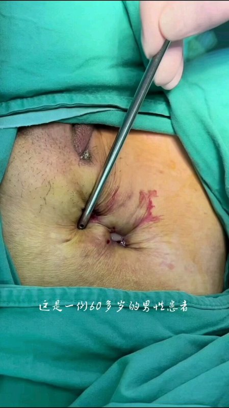 怎样才能防止腹股沟疝修补术后补片的排异反应？
