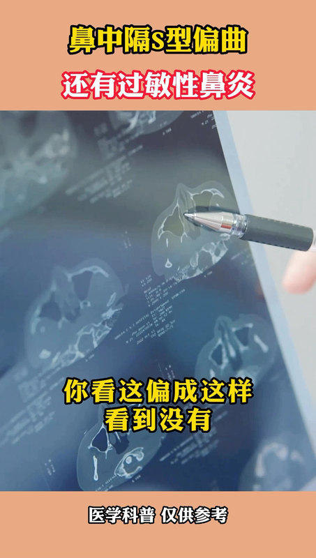 鼻中隔s型偏曲，还有过敏性鼻炎
