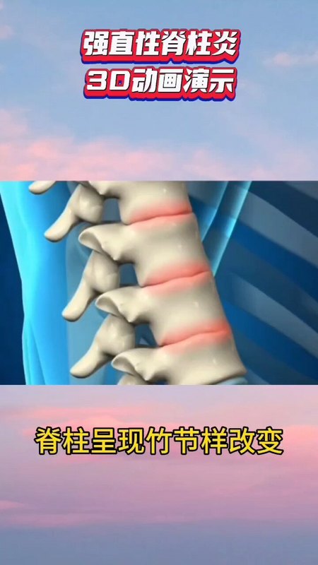 强直性脊柱炎3D动画解说