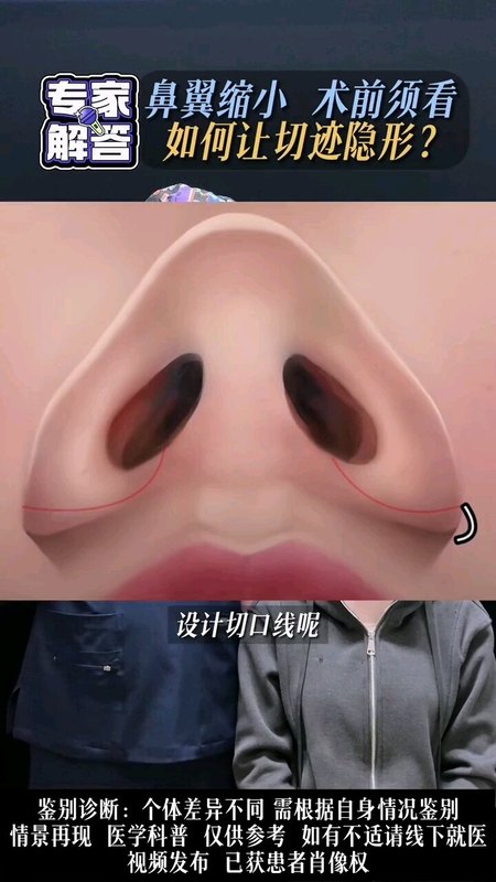 关于鼻翼缩小切迹隐形的问题，今日和大家分享一下。