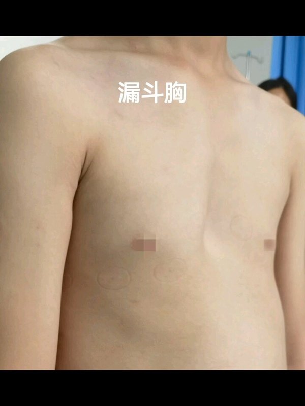 前胸骨骼惊奇也是病