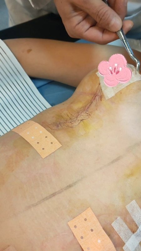 棒棒糖切口乳房手术后护理