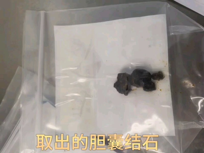 郑州人民医院南部院区针孔保胆取石展示