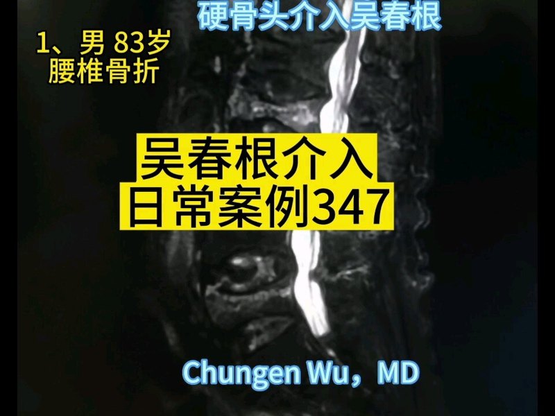 胸腰椎转移（含T1、T2）、腰椎骨折，吴春根介入日常案例记347