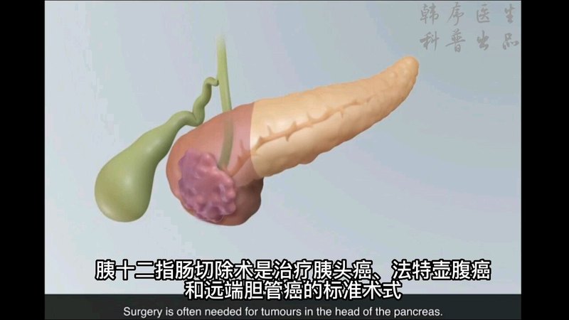 胰十二指肠切除手术是怎么做的？看完这个小视频秒懂！