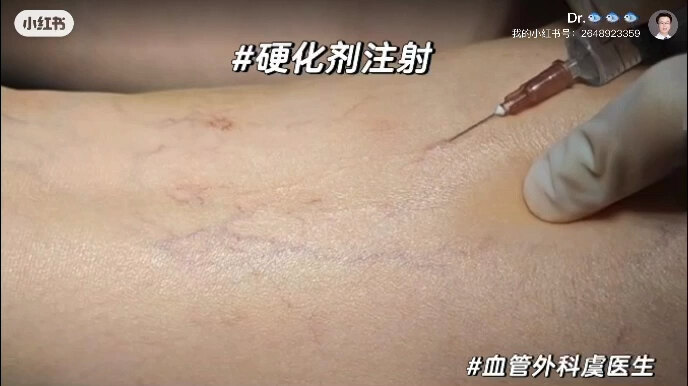 下肢静脉曲张硬化剂注射