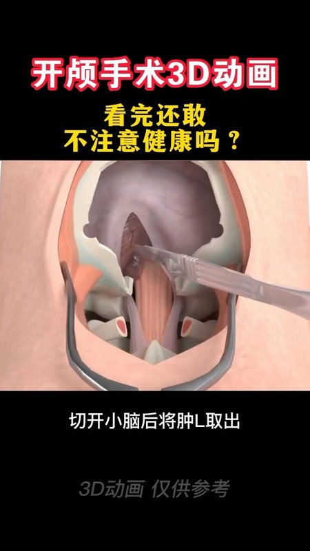 开颅手术的过程