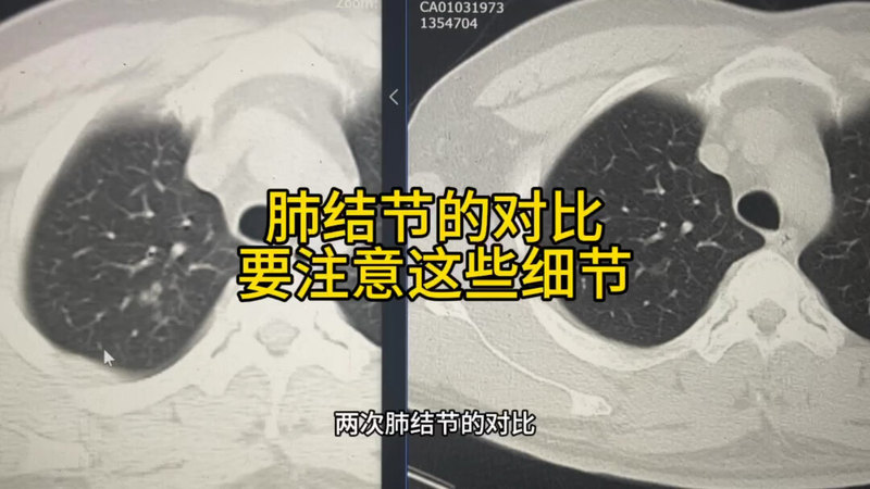 肺结节的对比以什么参照物为好，对比中不要忽视呼吸原因造成的假象
