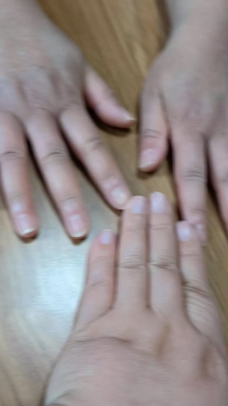 硬皮病患者手部变化