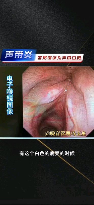 容易误诊为声带白斑的声带炎