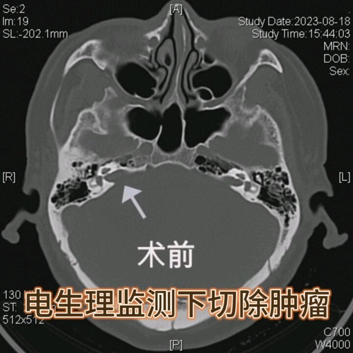 听神经瘤切除手术