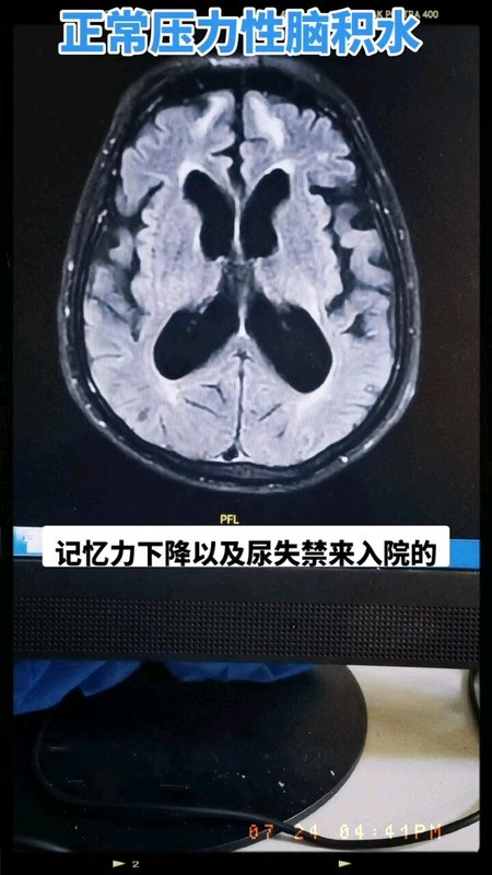 正常压力性脑积水的手术治疗