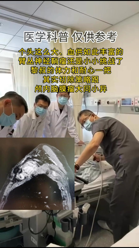 大家探头探脑的在看什么？超声下的臂丛神经鞘瘤