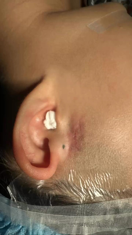 看看你家小孩耳朵前面有没有一个小针眼？这是先天性耳前瘘管，人群中约1.2%～2.5%的人一出生就有。