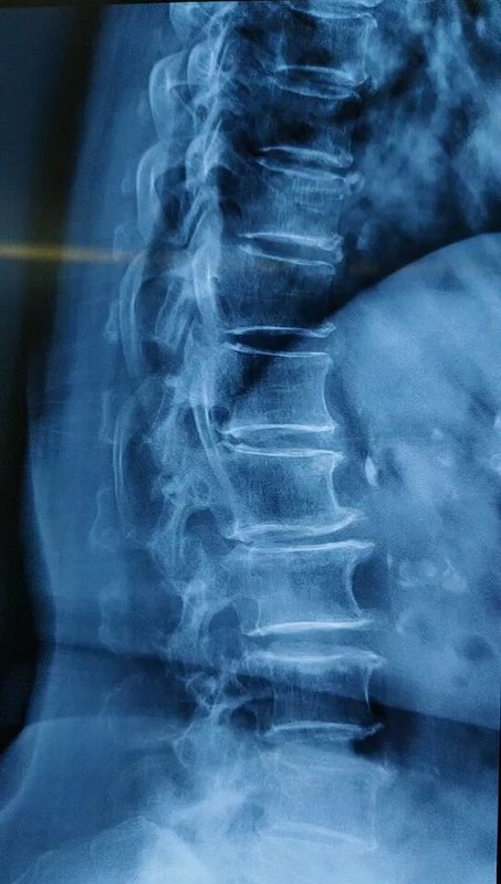 急诊74岁剧烈的腰腿痛，微创手术