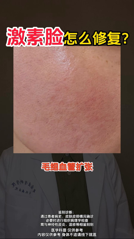 激素脸怎么治疗？