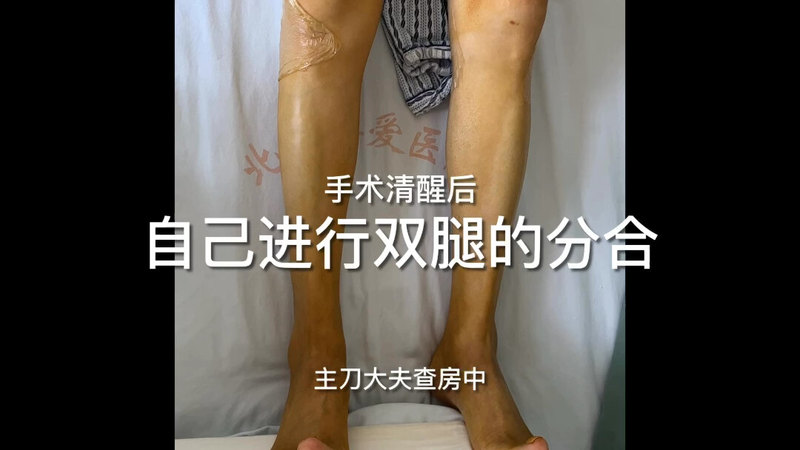 脊髓损伤后遗症，严重痉挛，显微外科技术下周围神经选择性切断手术清醒后，与手术前对比