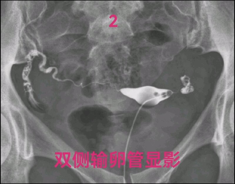 输卵管扭曲和粘连