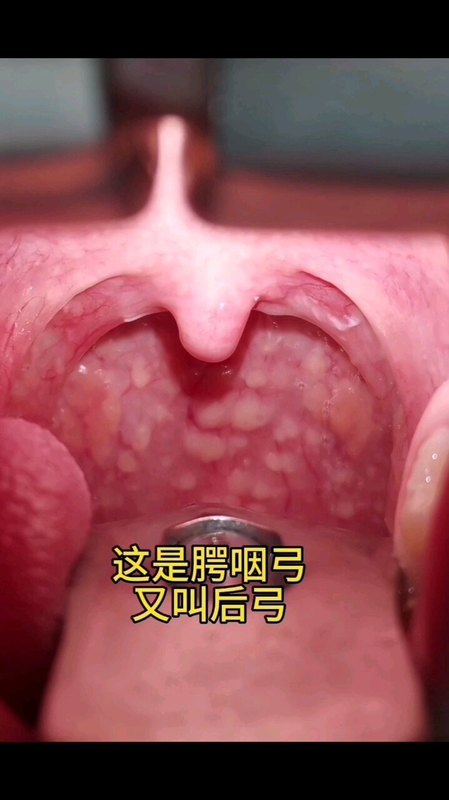 扁桃体肥大三度分度法，图片高清，简单易学！