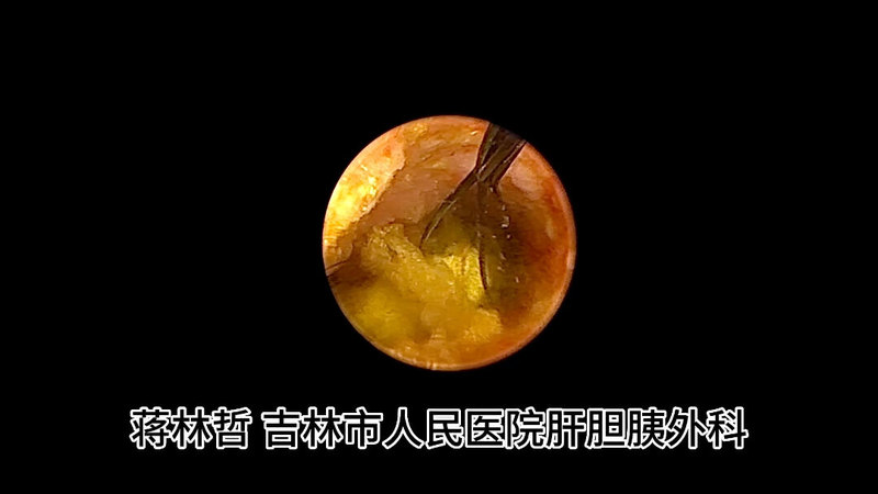 肝内胆管结石可以微创手术吗？
                    肝内胆管结石一直是肝胆外科治疗难点，目前可以经微创方法解决！