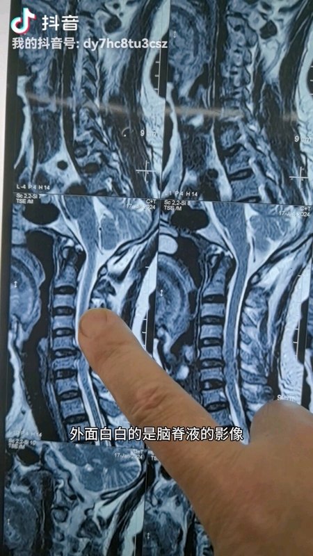 C5/6间盘突出神经根型颈椎病，教你看核磁共振片子