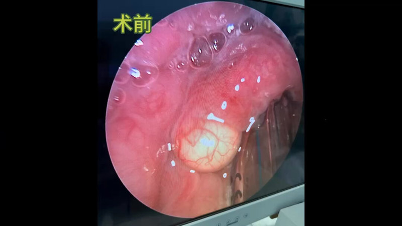 会厌囊肿激光切除术