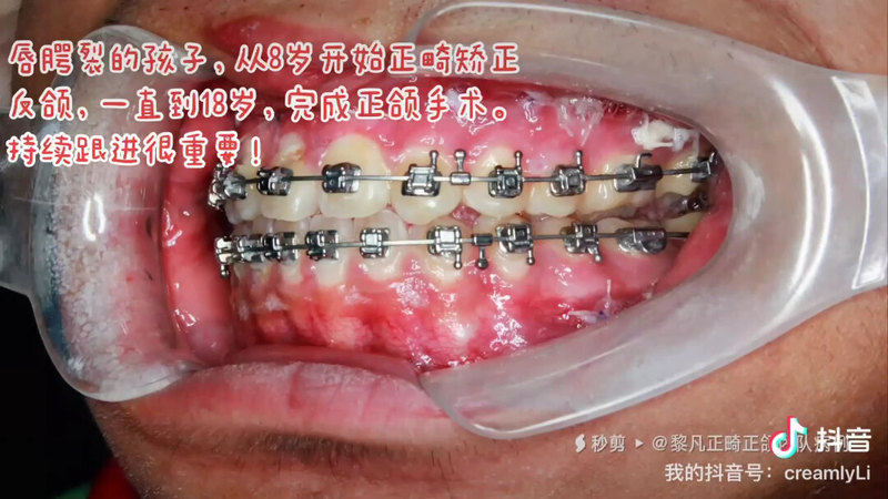 視頻封面