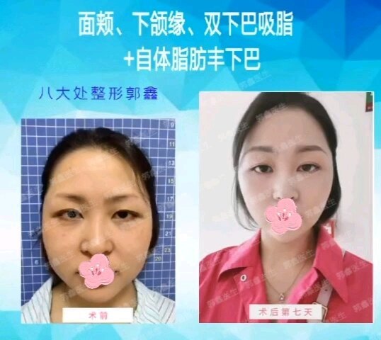 面颊双下巴吸脂