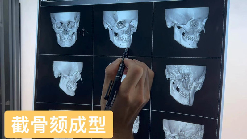 截骨颏成型