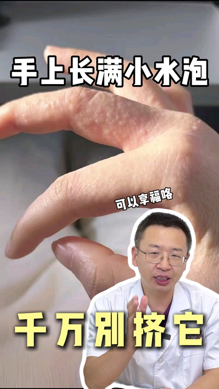 手上长满小水泡，千万别挤它＃健康的答案 ＃医学科普