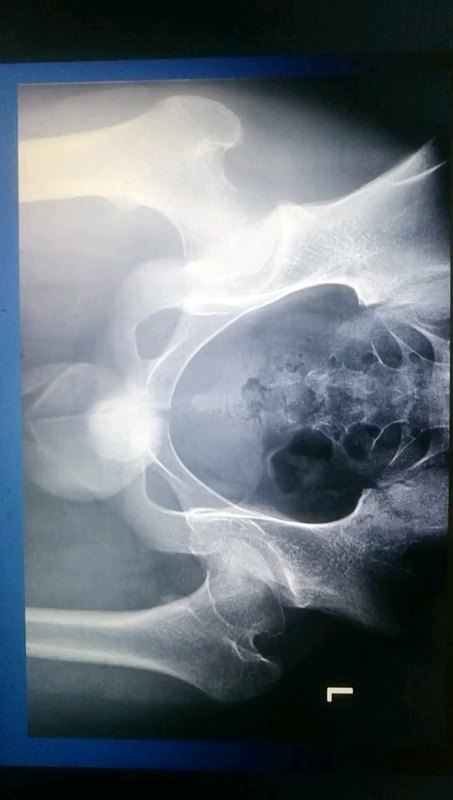 儿童股骨头坏死（perthes病）为什么需要治疗