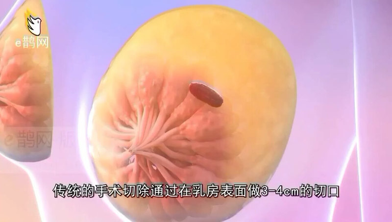 乳腺麦默通手术介绍（视频来自网络，非自己制作）