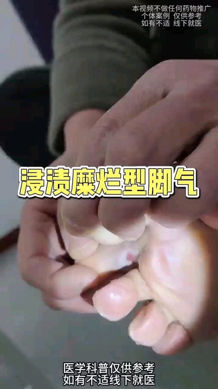 浸渍糜烂型脚气