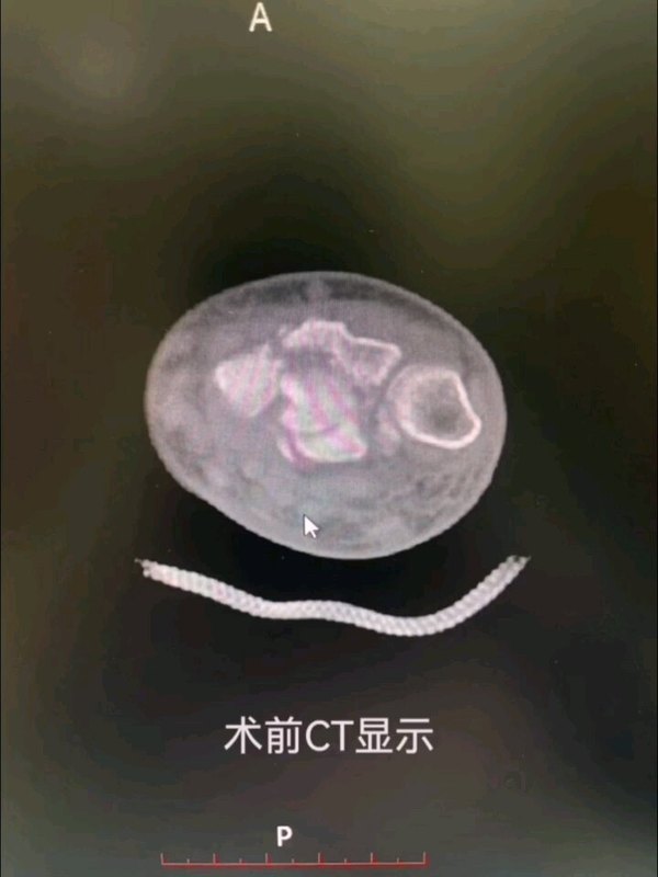 ＃医学科普   经多年探索和研究，对累及关节面的桡骨远端严重骨折，形成了我们自己的手术体系，达到了骨