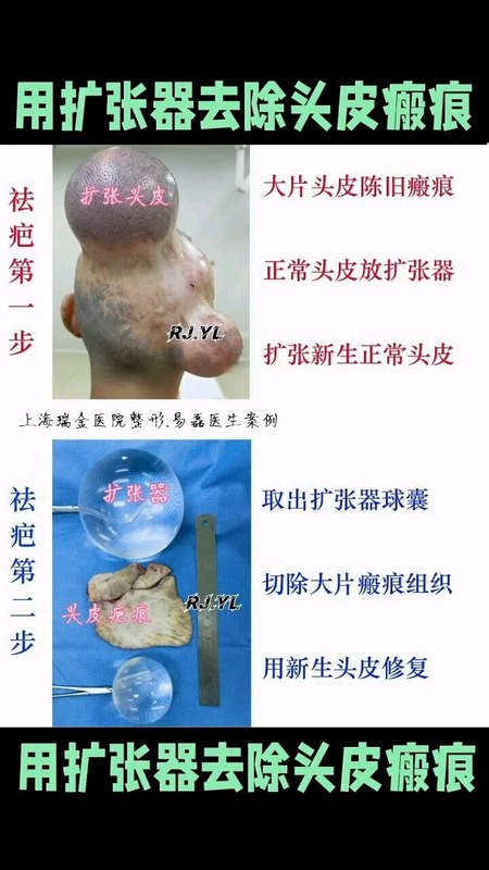 如何去除大片头部疤痕？
